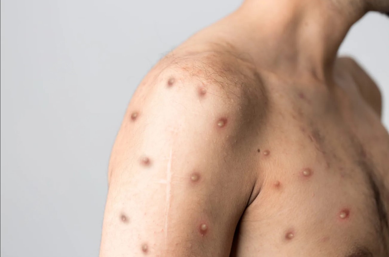 Europe ‘epicentre’ of monkeypox outbreak: WHO says