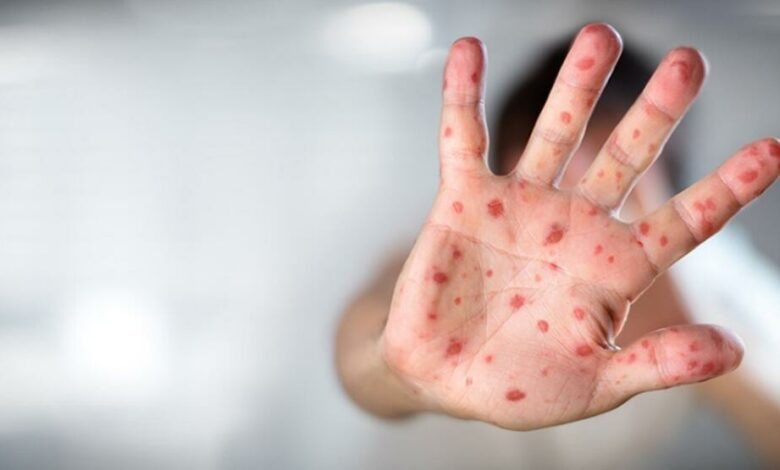 Russia reports first case of monkeypox