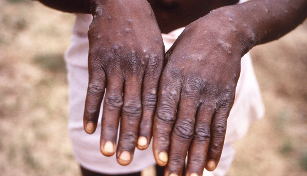 Kenya Reports First Mpox Case