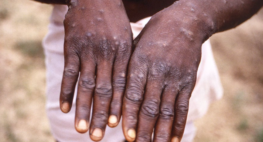 Kenya Confirms Second Case of Mpox