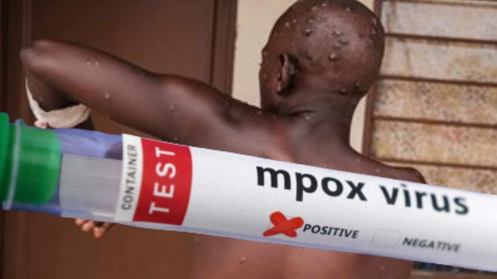 Uganda Confirms Mpox Case In Prison