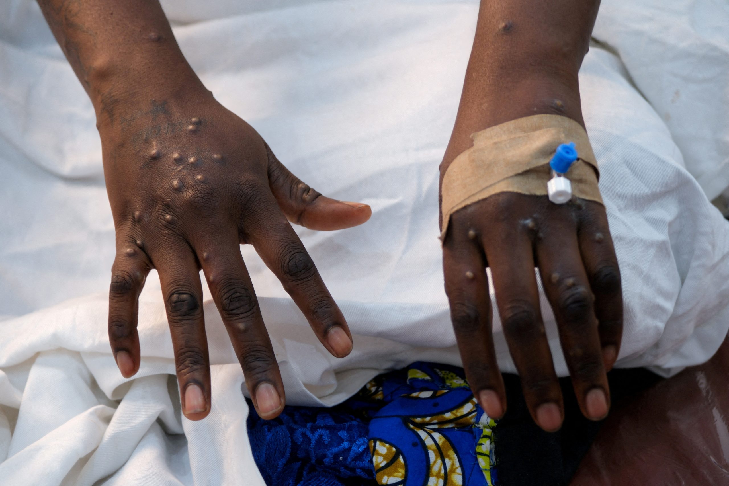 CDC:Maambukizi ya Mpox yamepungua kidogo Barani Afrika